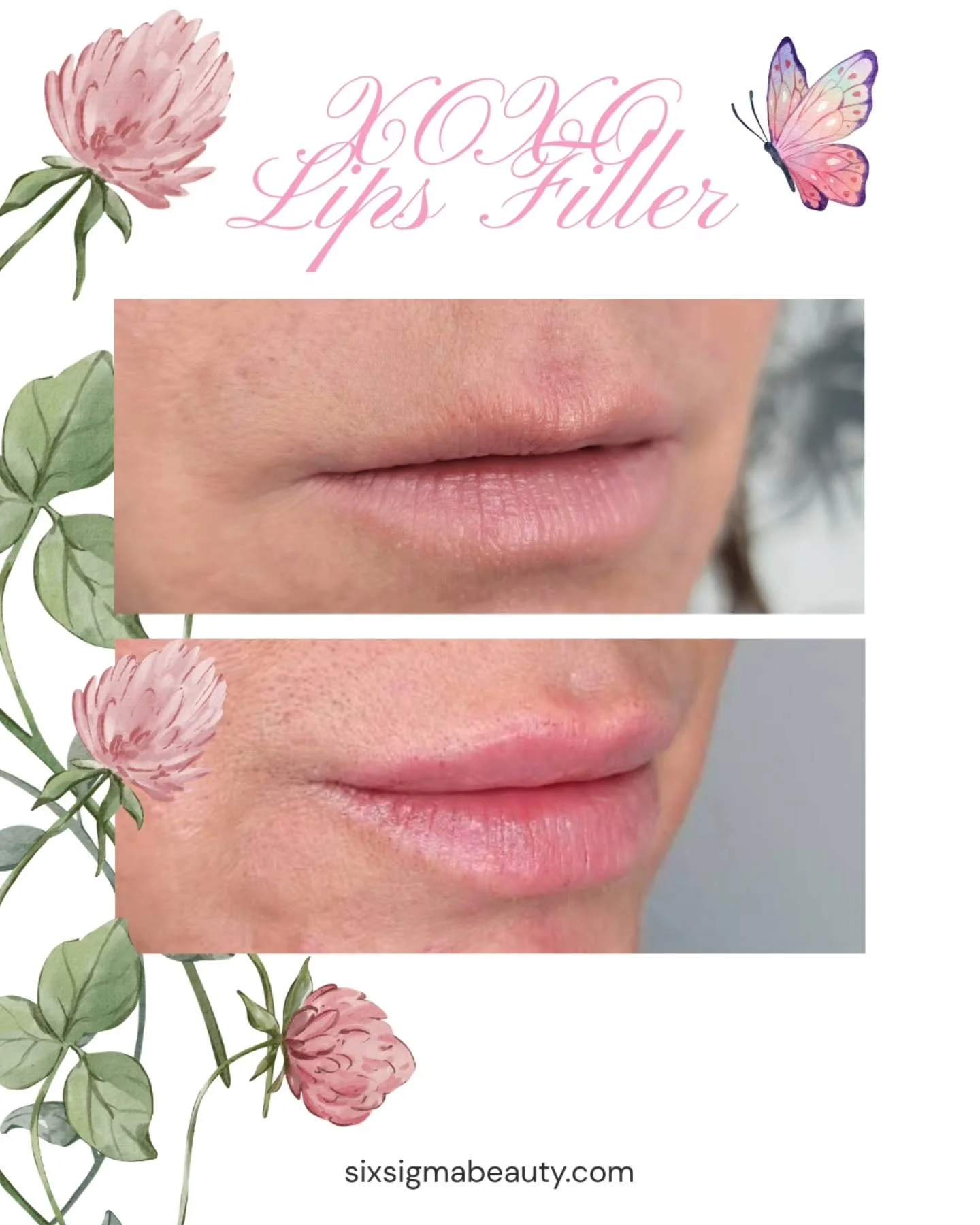 SLOW &amp; STUNNING- Top photo? Where we started 2 years ago. Bottom photo? RIGHT after her 3rd session 😍 

Our approach? Strategic placement. Gradual volume building. We work WITH your natural lip anatomy, not against it, to create results that enh