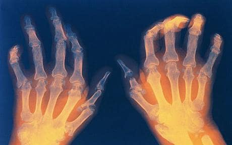 Rheumatoid Arthritis – Healing & Management from AN HOLISTIC PERSPECTIVE