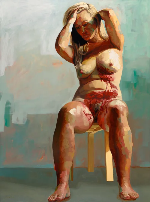 Endometriosis+(Coagulate).jpg
