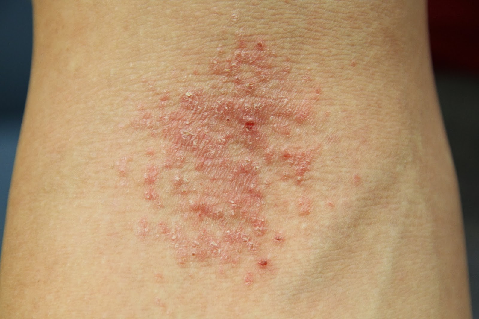 Eczema