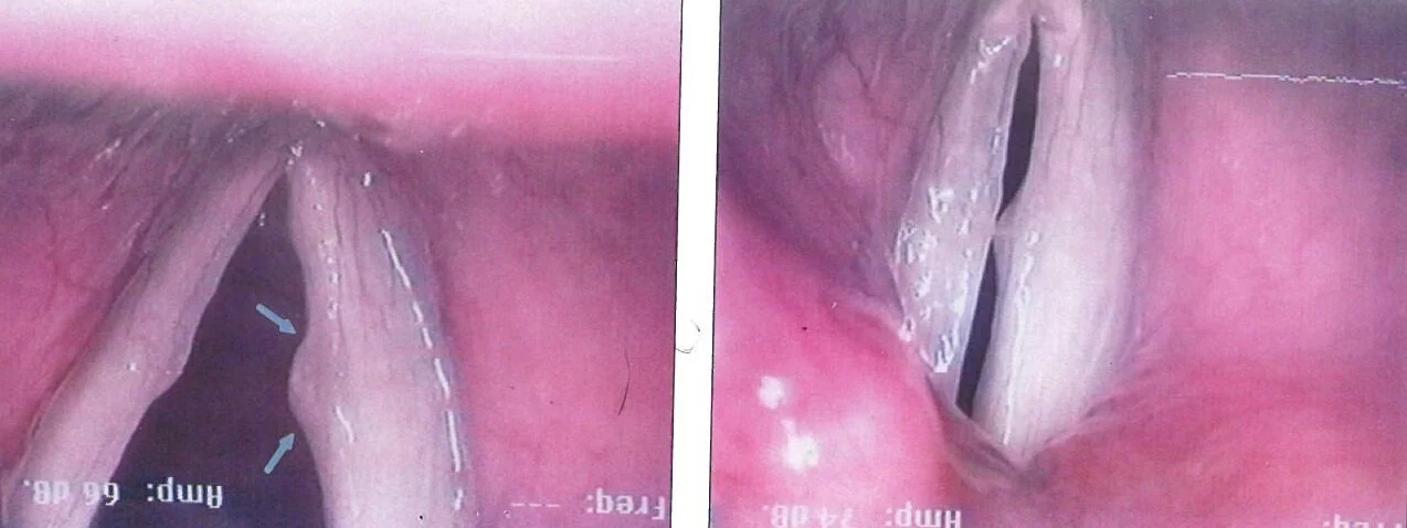 Reach right vocal fold cyst and left reactive mass in abduction (open)(a) and aduction (closed)(b). From Sataloff, R.T., Hawkshaw, M.J., Sataloff, J.B., DeFatta, R.A., and Eller, R.L. Atlas of Laryngoscopy, Third Edition. San Diego, California: Plural Publishing, Inc.; 2012.