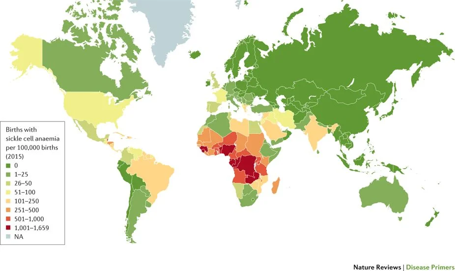 20 JUNE 2018: ESTIMATED NUMBERS OF BIRTHS WITH SICKLE CELL ANAEMIA, 2015