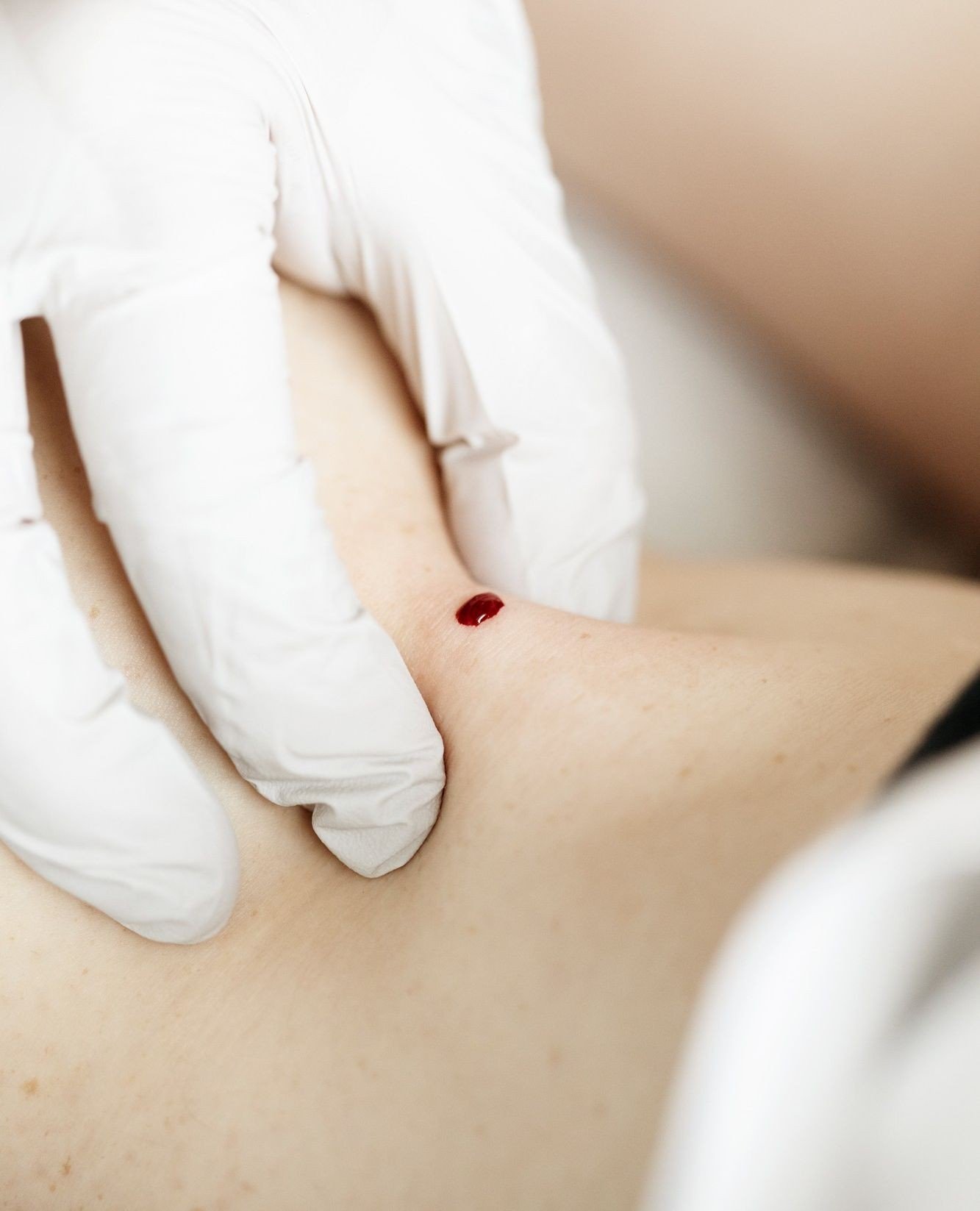 🩸 Why we bleed people on purpose🩸 ⁠
⁠
As Chinese medical practitioners, we offer a range of treatments like acupuncture, cupping, moxa, and gua sha. But have you heard about micro-letting? This lesser-known technique involves pricking the skin with