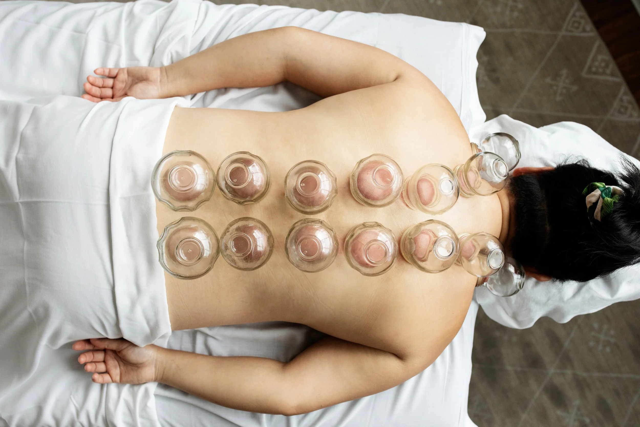 A patient with medium tone skin relaxes on a treatment table with cups on her back to relieve pain and tension.