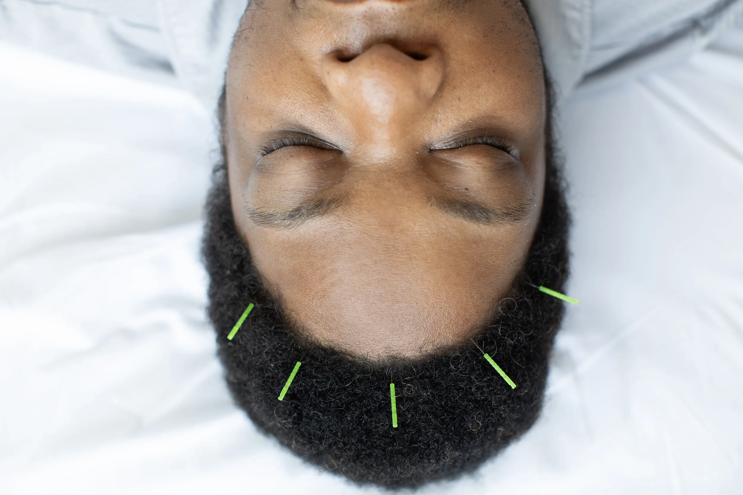 A person with dark skin relaxes with their eyes closed on a treatment table, with small acupuncture needles inserted along their hairline.