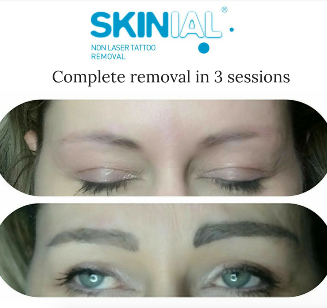 NON LASER PERMANENT MAKEUP REMOVAL — Skin Deep Clinic