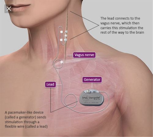 Image 09303: Cervical Nerve Stimulator Device Placement Surgery Illustration