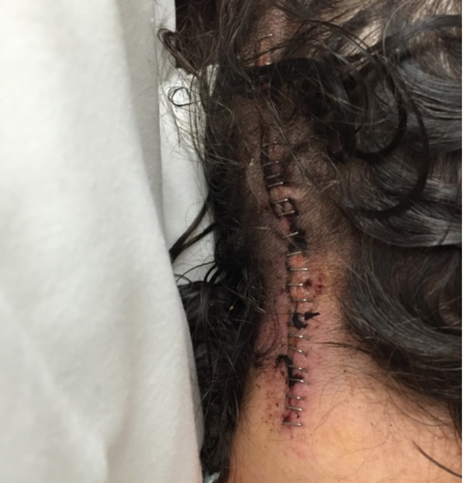 Stroke Survivor: Female, 30 / Caregiver: Male 33