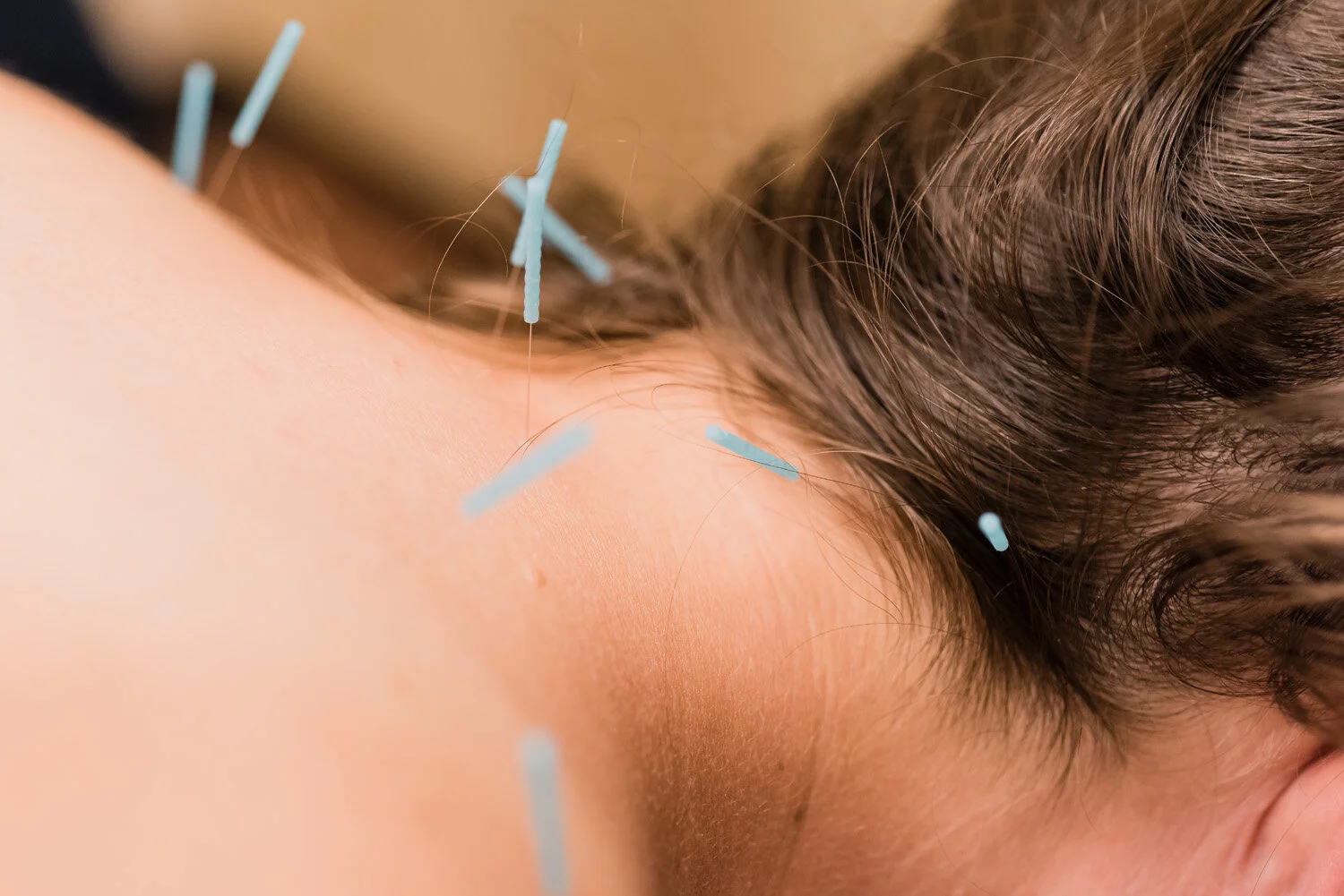 Acupuncture needles at the best acupuncture in Louisville, CO