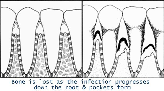 THE SPACES BETWEEN THE TOOTH AND GUM ARE CALLED PERIODONTAL POCKETS
