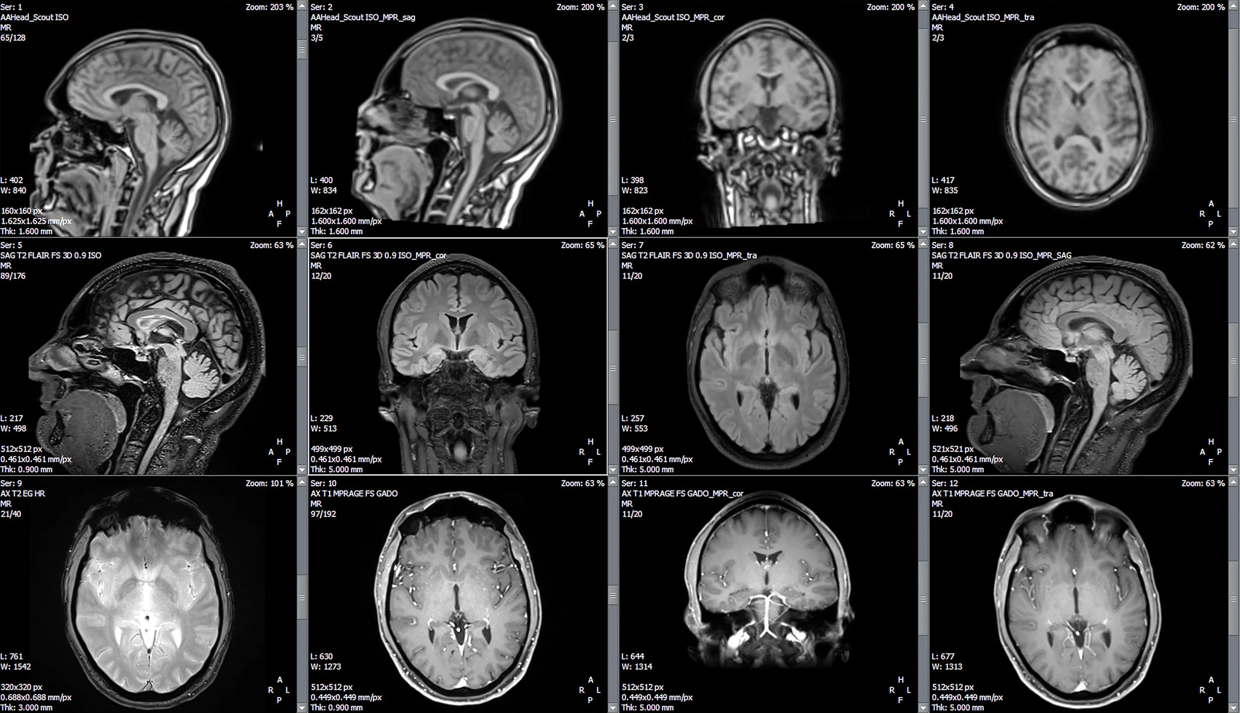 Traumatic Brain Injury (TBI)