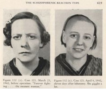 Schizophrenic woman before and after lobotomy.