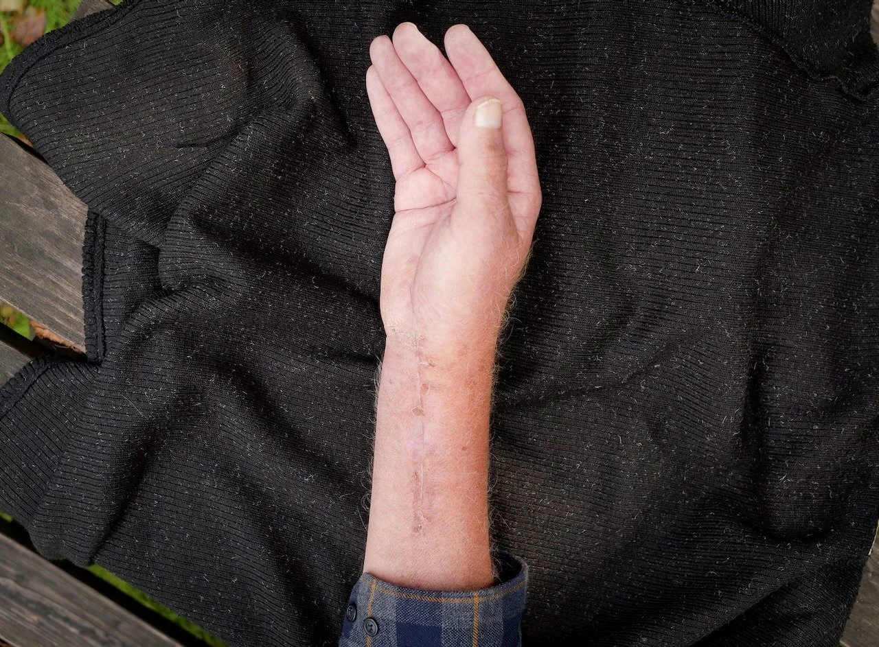 8 weeks after surgery on my wrist. I am blessed with grate genes when it comes to healing. That said, this wrist brings me to tears of pain and frustration. Onwards we go.