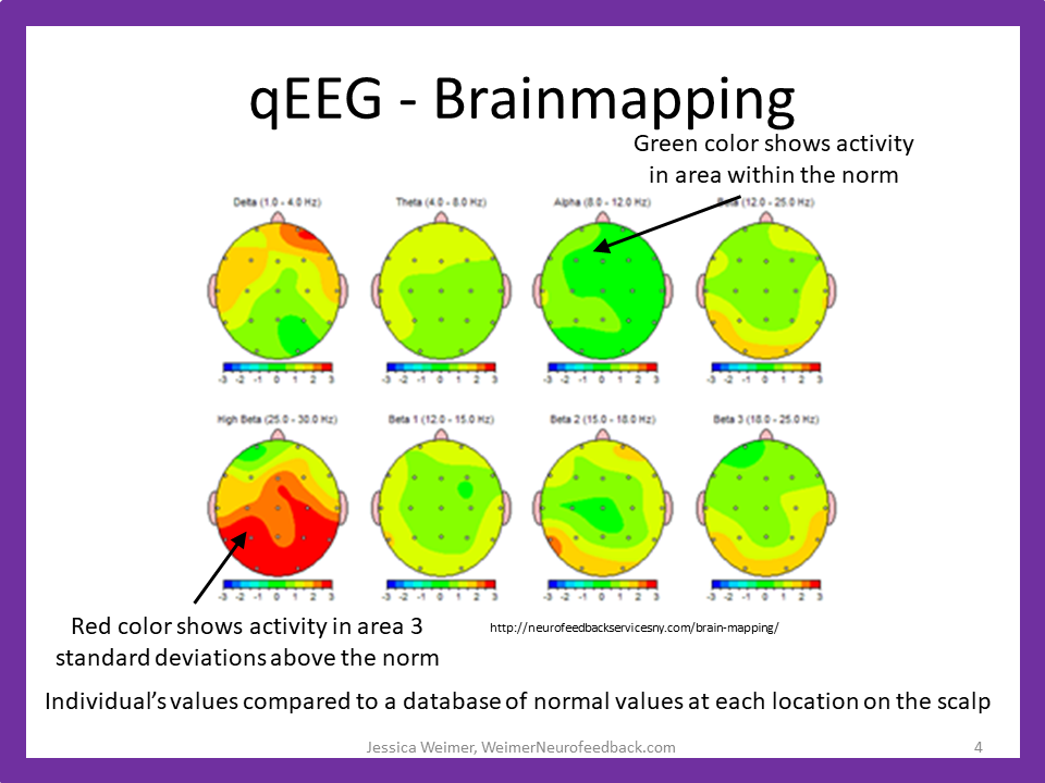 Pictorial Representation of Neurofeedback qEEG Brainmap