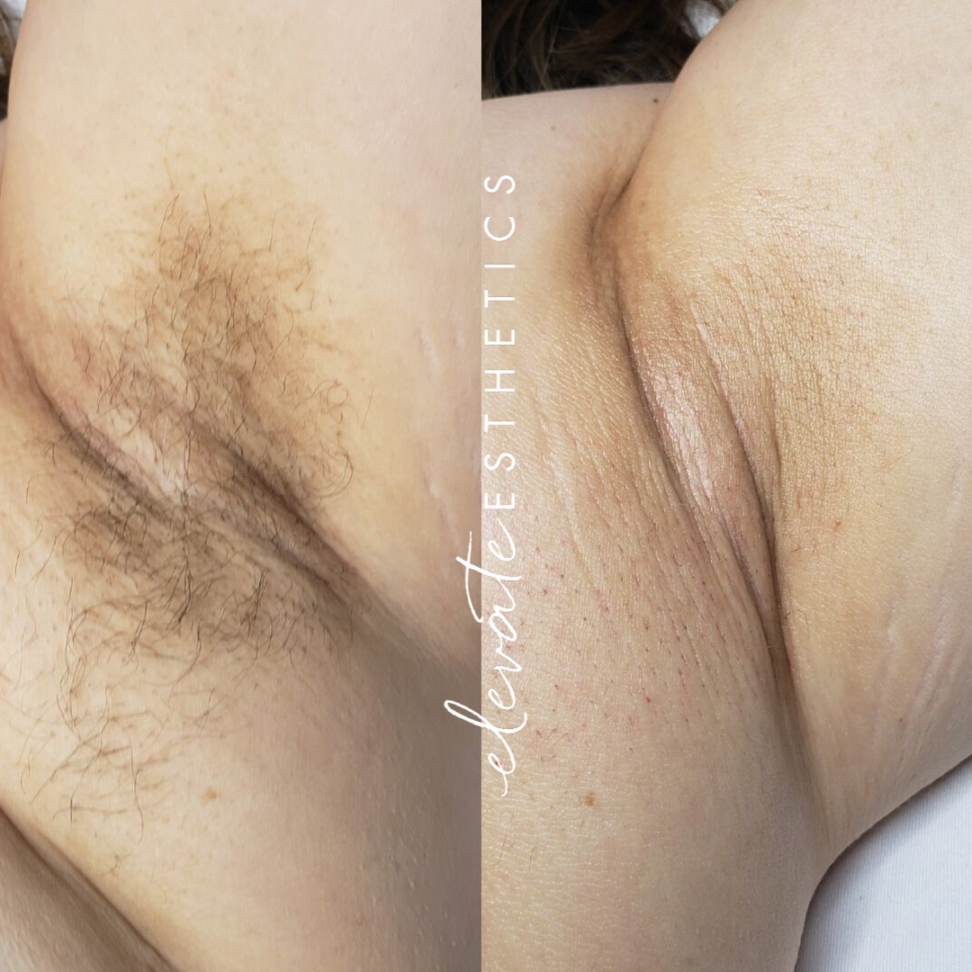 Before_after underarm wax.png