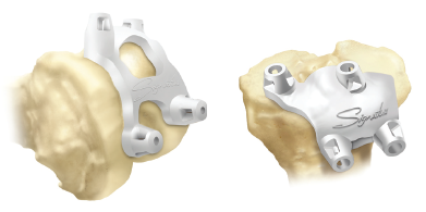 Personalised positioning guides for total knee replacement