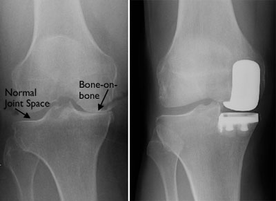 Arthritis affecting only the medial compartment (L) and x-ray showing a partial knee replacement (R)