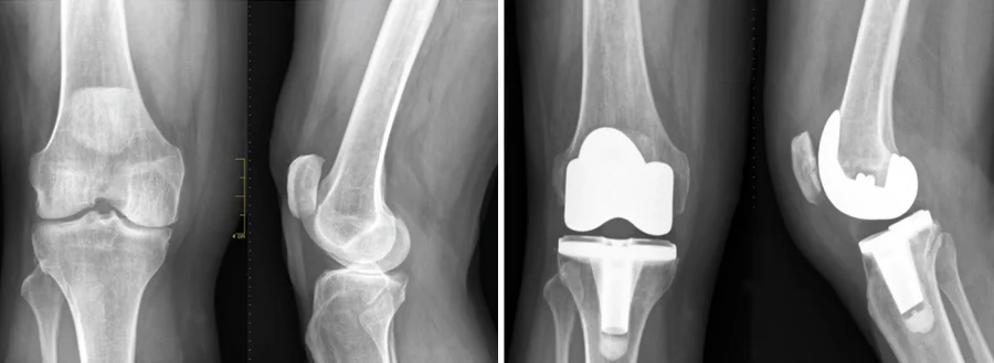 X-ray taken after Total Knee Replacement