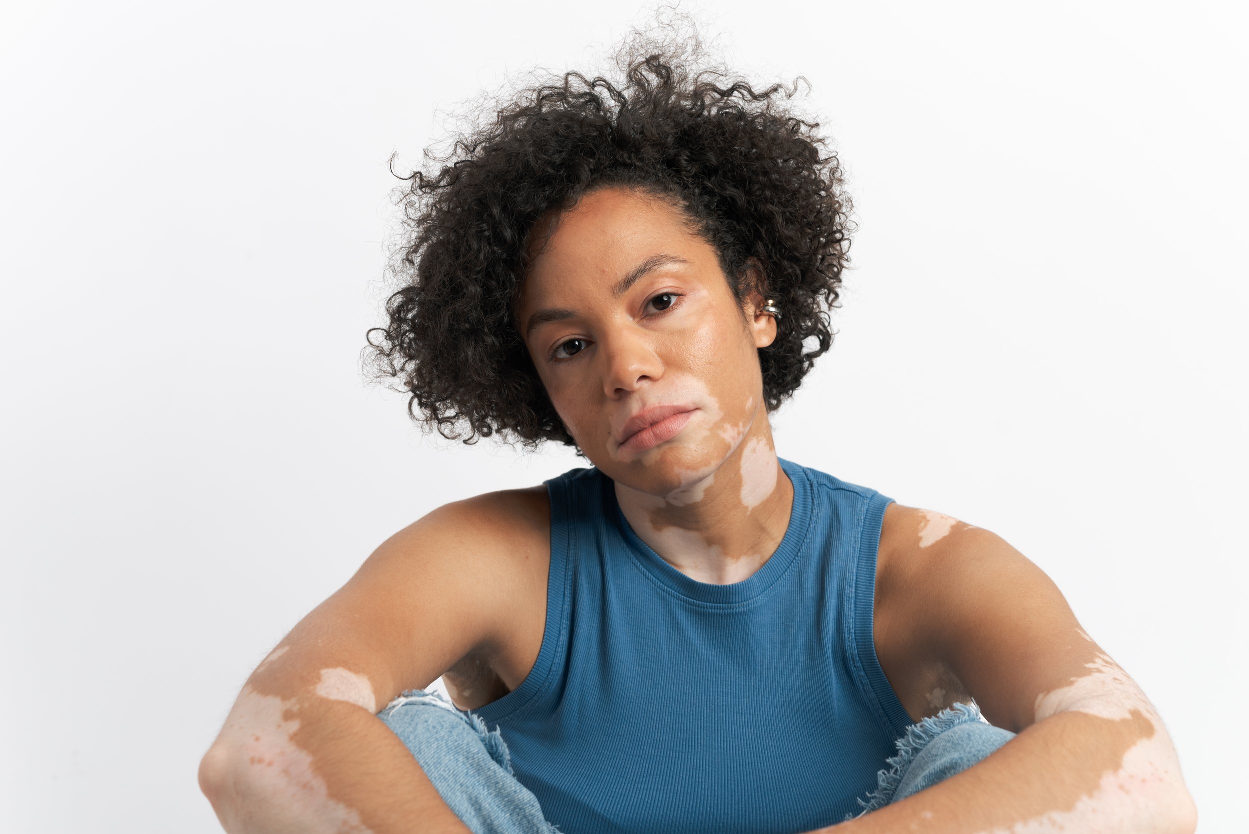 Young woman with curly hair wearing a blue sleeveless top sitting against a white background, exhibiting patches of white skin condition on her face, neck, and arms.