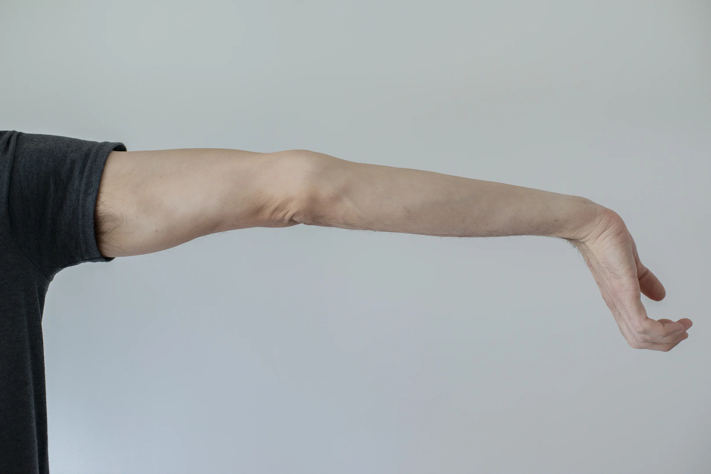 Elbow Hypermobility In Yoga