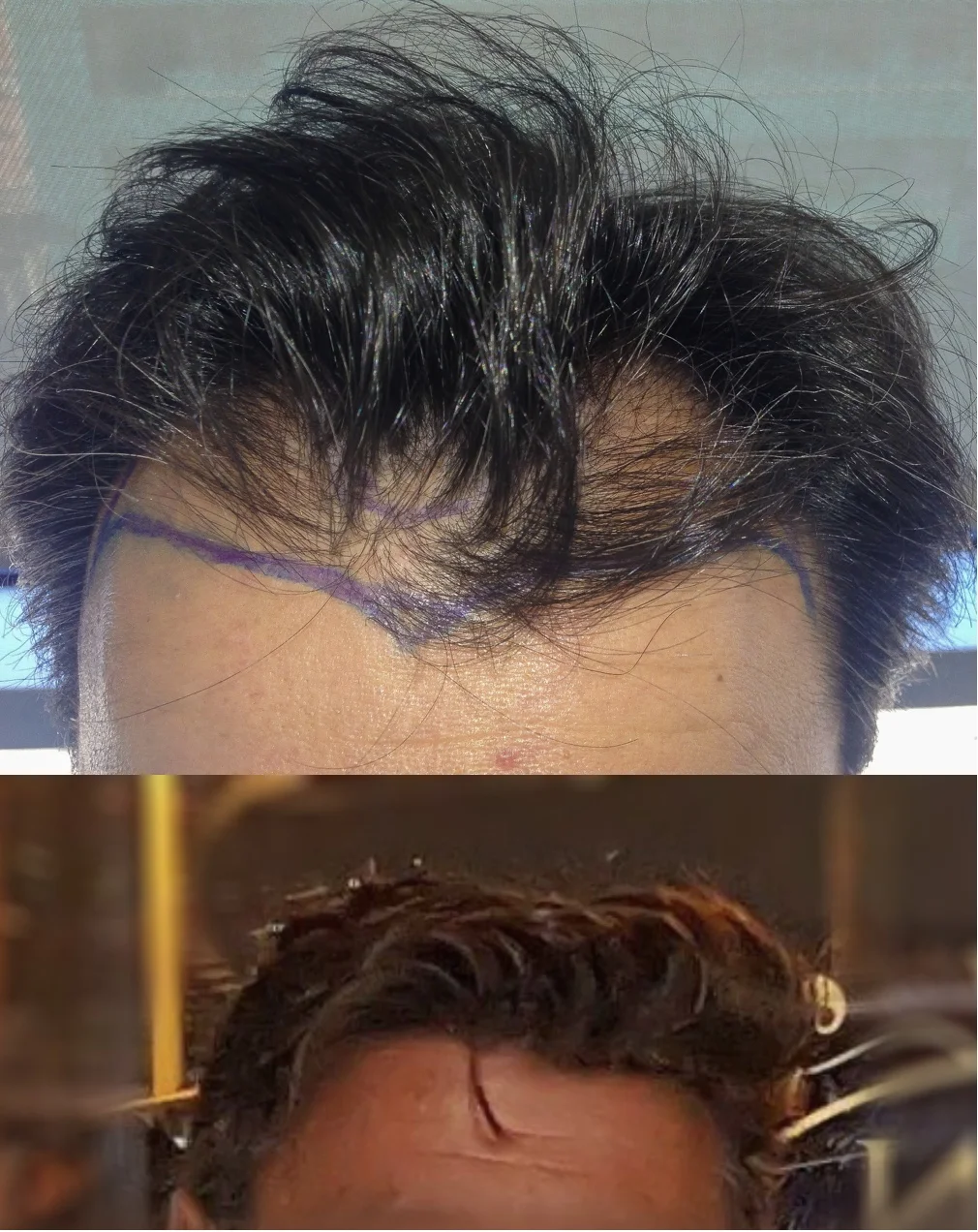 Copy Of Copy Of Results Dr Bruno Ferreira Leading Edge Hair Transplant Surgery