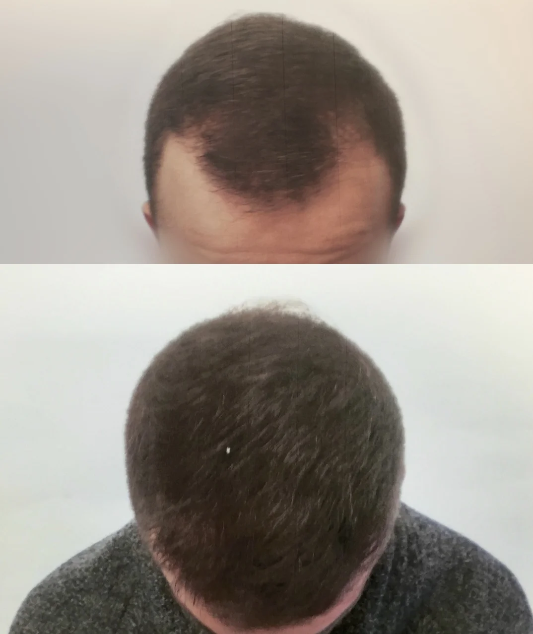 Copy Of Copy Of Results Dr Bruno Ferreira Leading Edge Hair Transplant Surgery