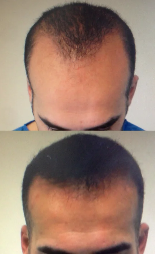Copy Of Copy Of Results Dr Bruno Ferreira Leading Edge Hair Transplant Surgery