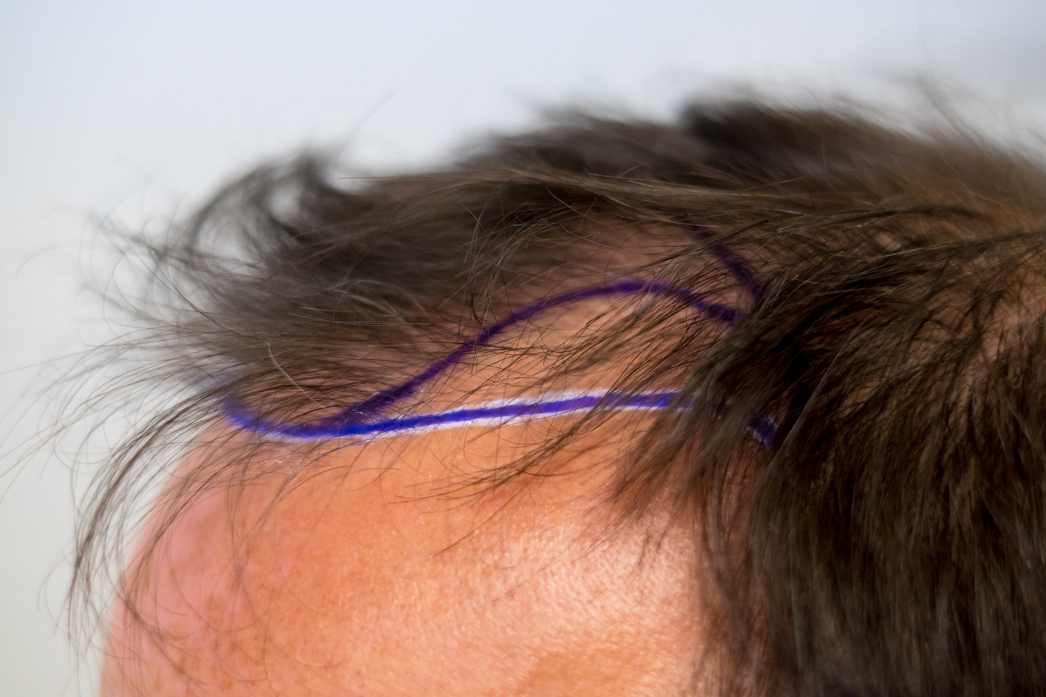 What is FUE Hair Transplantation? — DR. BRUNO FERREIRA - Leading Edge Hair  Transplant Surgery