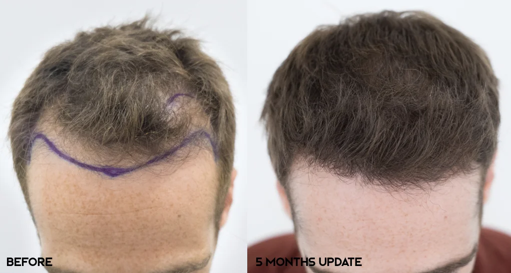 Results Dr Bruno Ferreira Leading Edge Hair Transplant Surgery