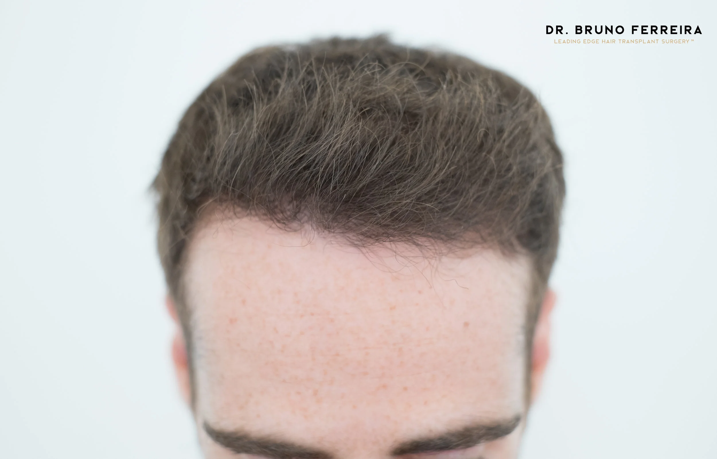 Results Case 1 Dr Bruno Ferreira Leading Edge Hair Transplant Surgery