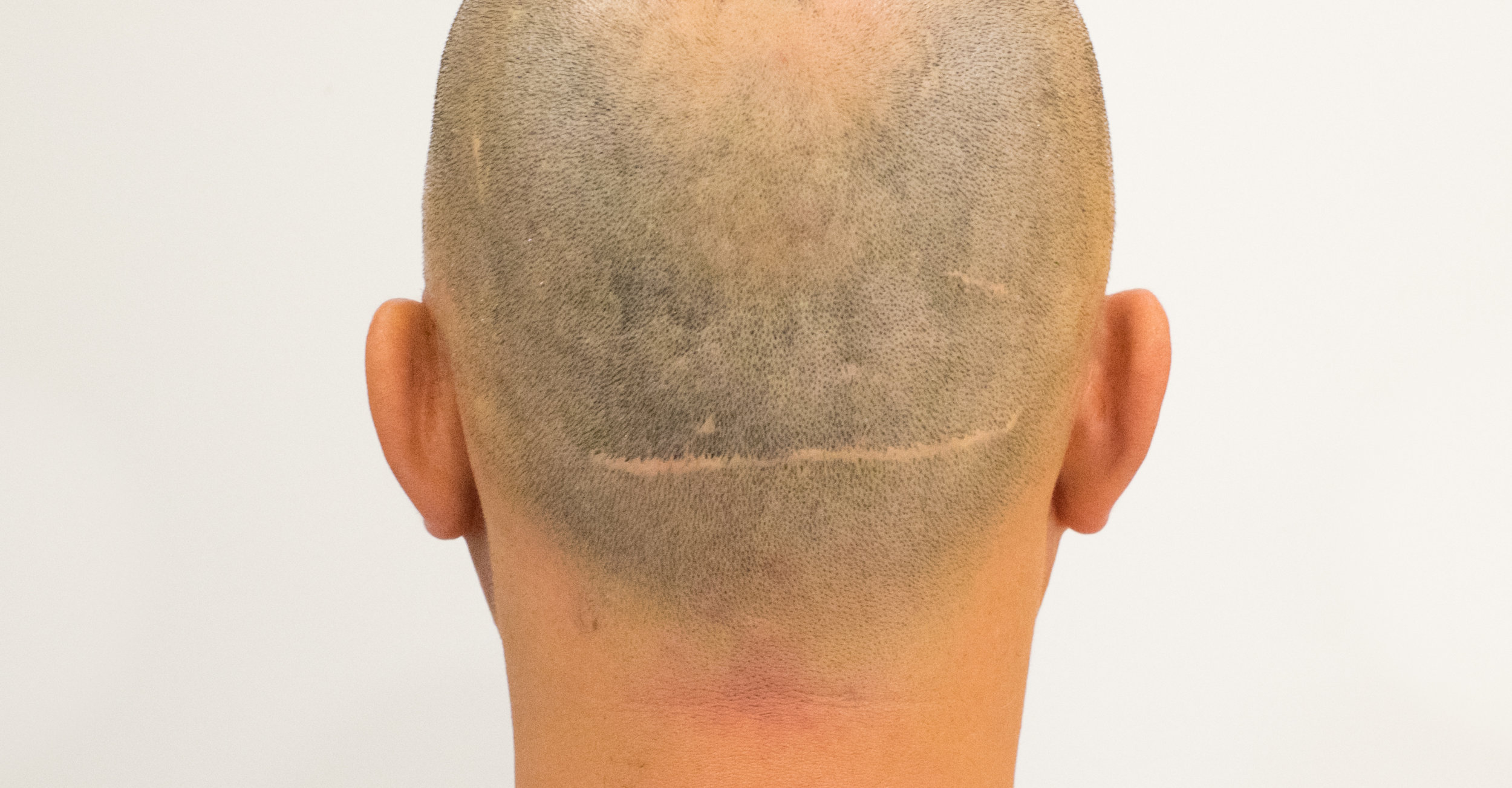 Cicatrizes — DR. BRUNO FERREIRA Leading Edge Hair Transplant Surgery