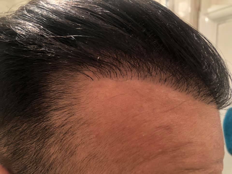 What's Behind a Great Hairline? — DR. BRUNO FERREIRA - Leading Edge Hair  Transplant Surgery