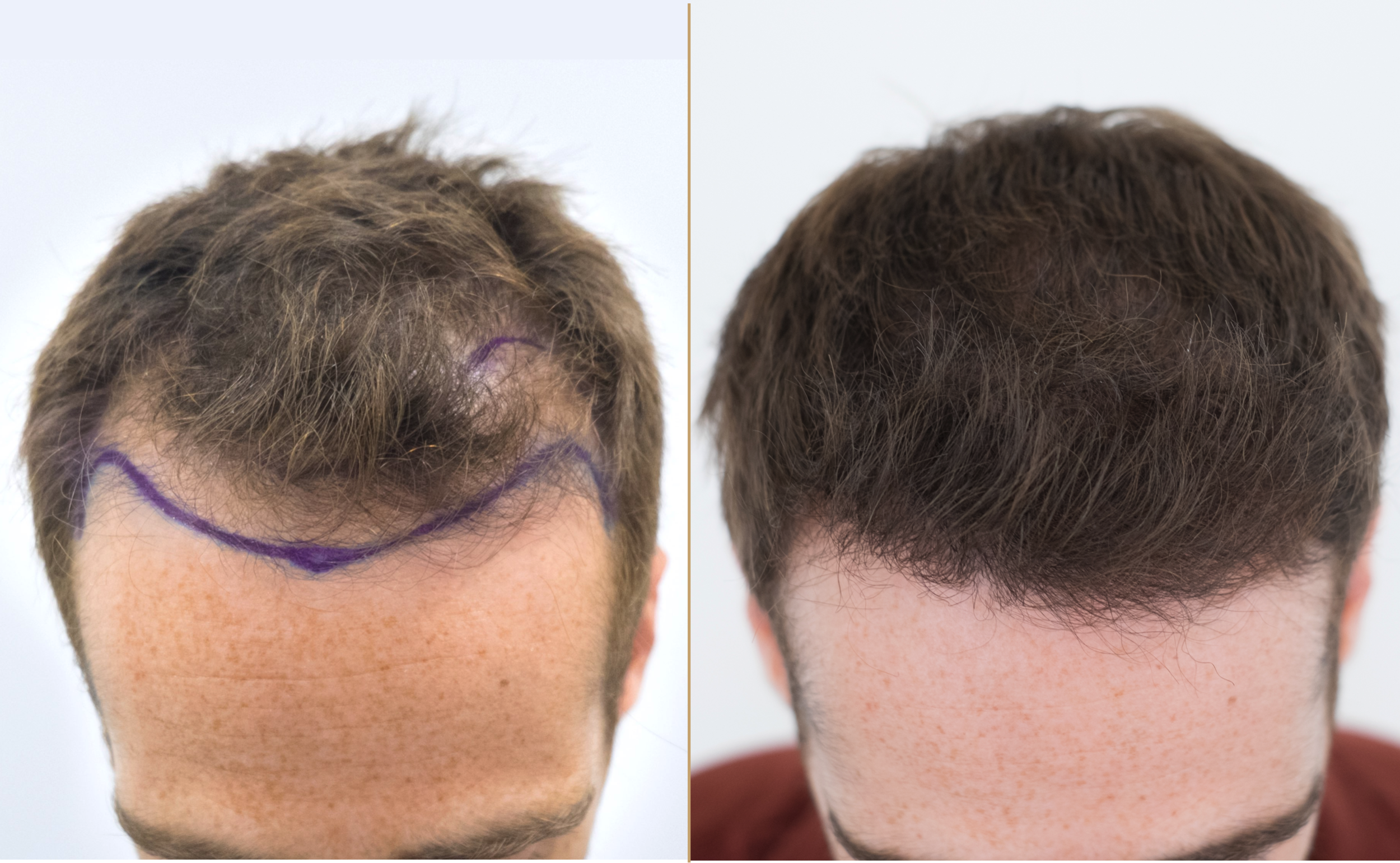 DR. BRUNO FERREIRA - Leading Edge Hair Transplant Surgery DR. BRUNO FERREIRA - Leading Edge Hair Transplant Surgery