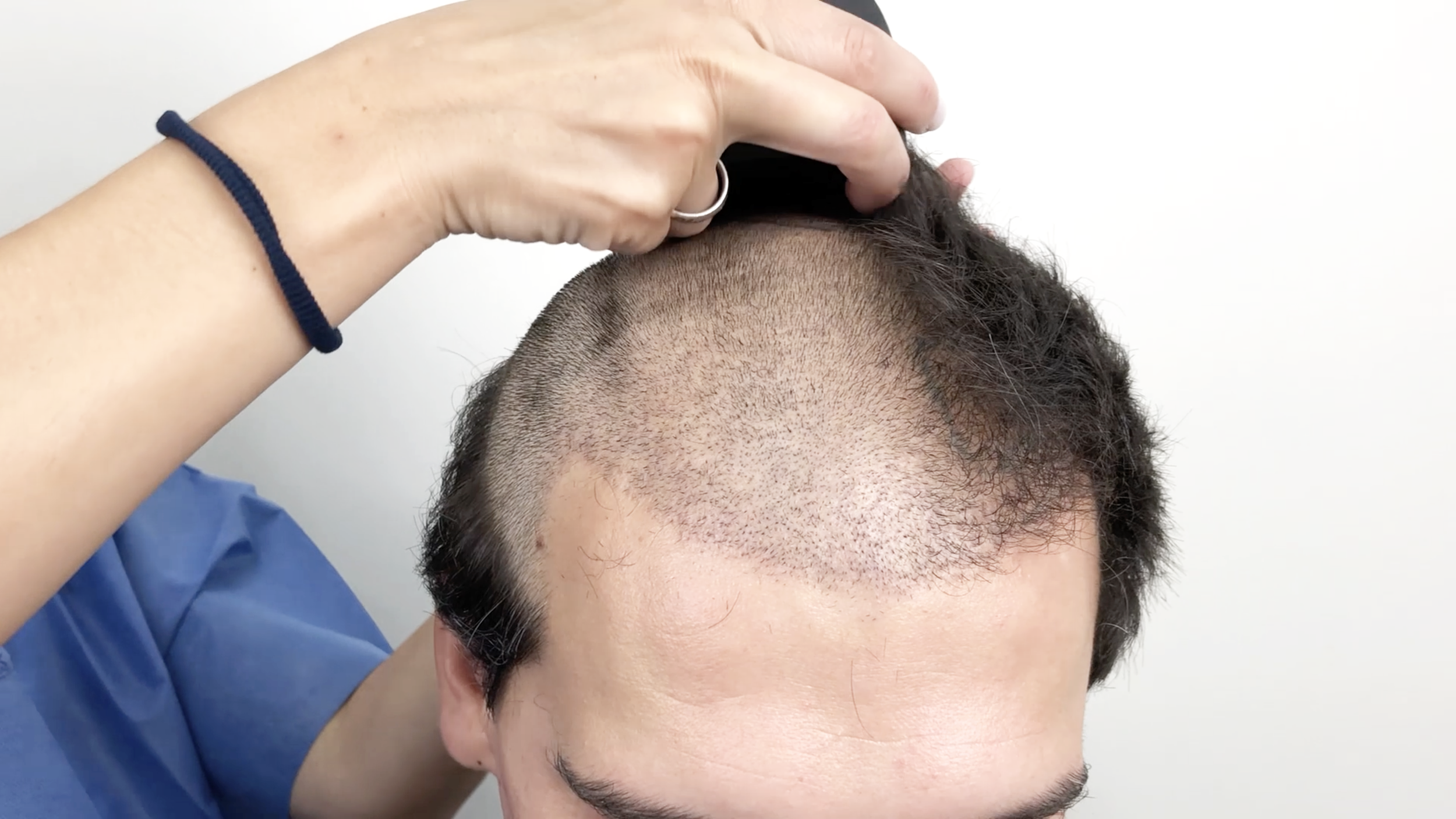 The importance of Shaving — DR. BRUNO FERREIRA - Leading Edge Hair  Transplant Surgery