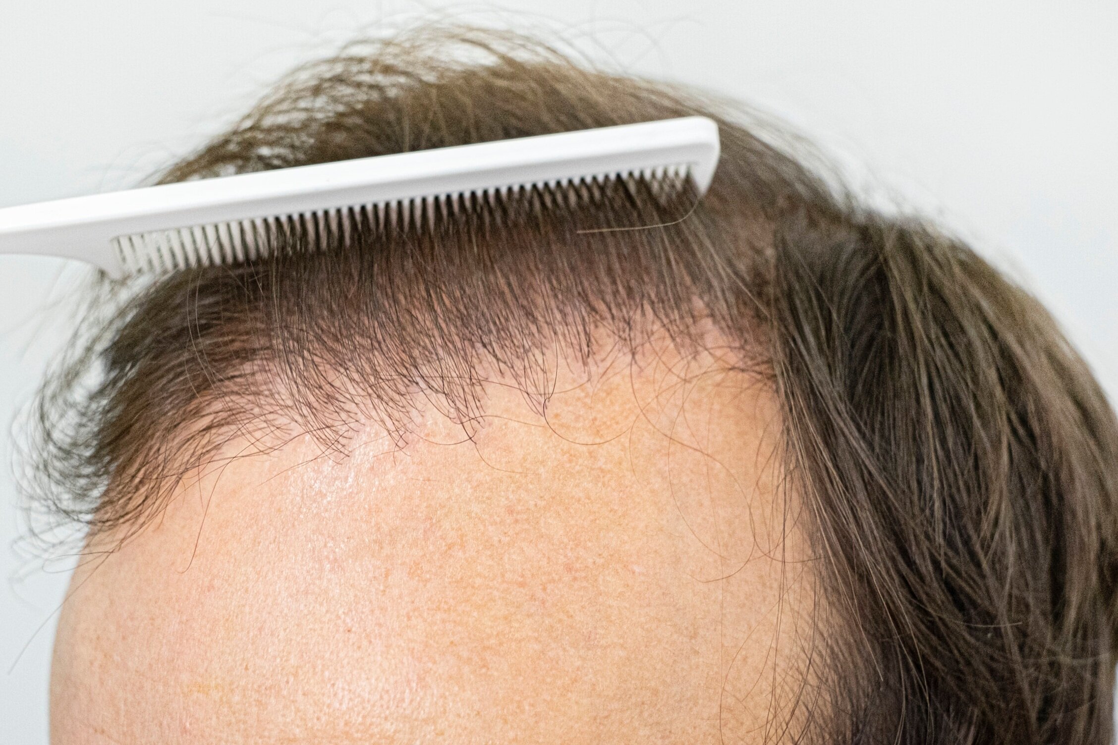Hair Transplant Clinic, Services, Treatment, Pune, India