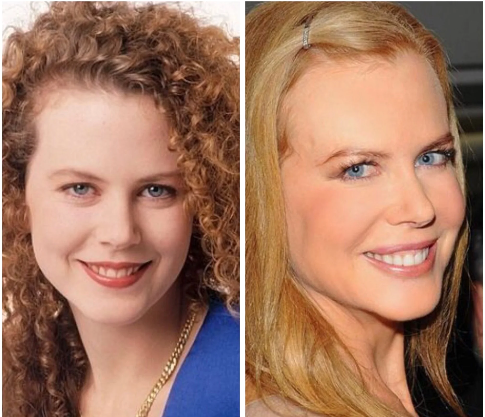 Actress Nicole Kidman ages beautifully. In these photos, the obvious difference (besides hairstyle) are largely due to changes in facial fat distribution (less fat in the temples, forehead, and sides of face). 