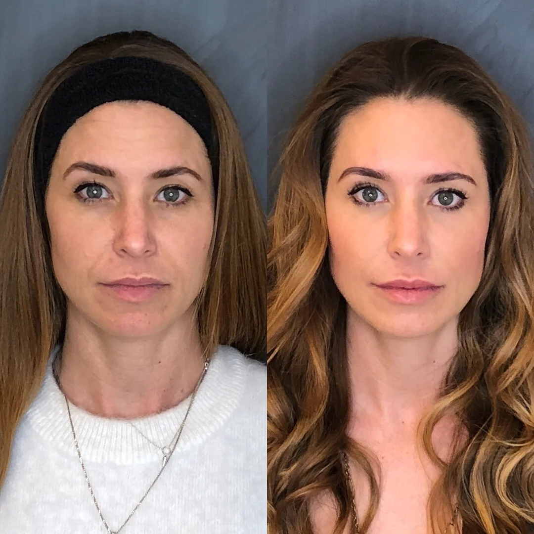 A Spring Make Over with Belotero Filler