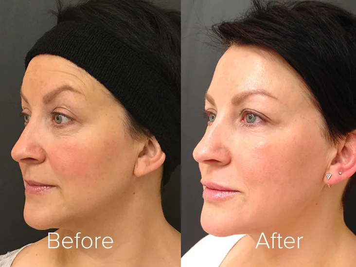 botox-before-after-thermae.jpg