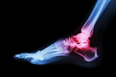 32505827_S_foot_xray_fracture_heel_bone_spur_injury.jpg