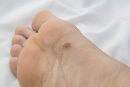 squamous papilloma foot