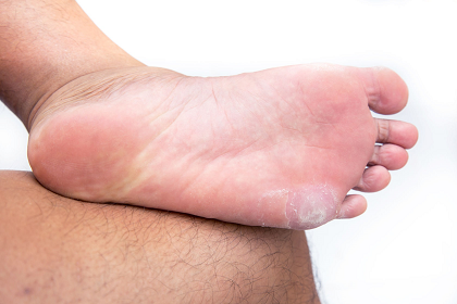 39809924_L_Corns_Feet_Toes_Bottom of the Feet.png