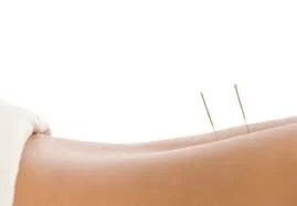 Acupuncture for back pain