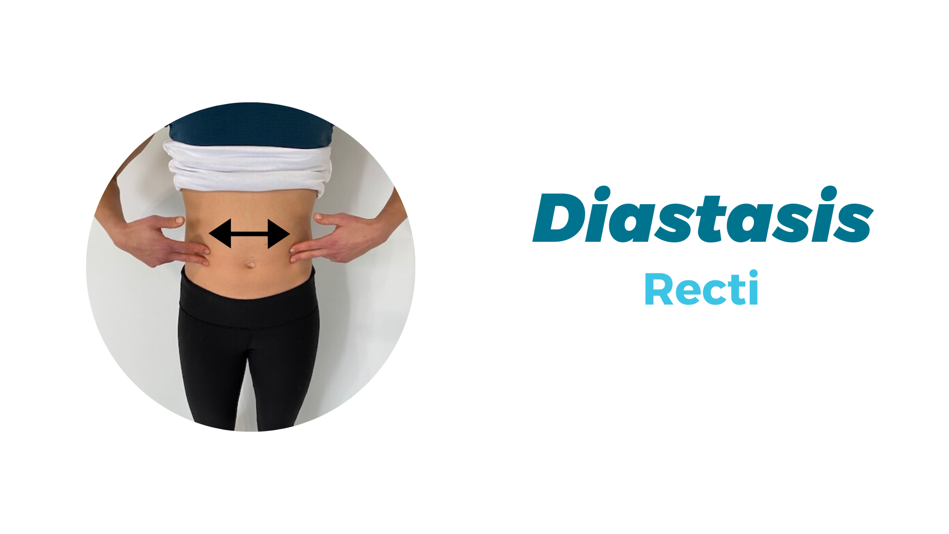 Diastasis Recti — Radius Physical + Sports Rehab
