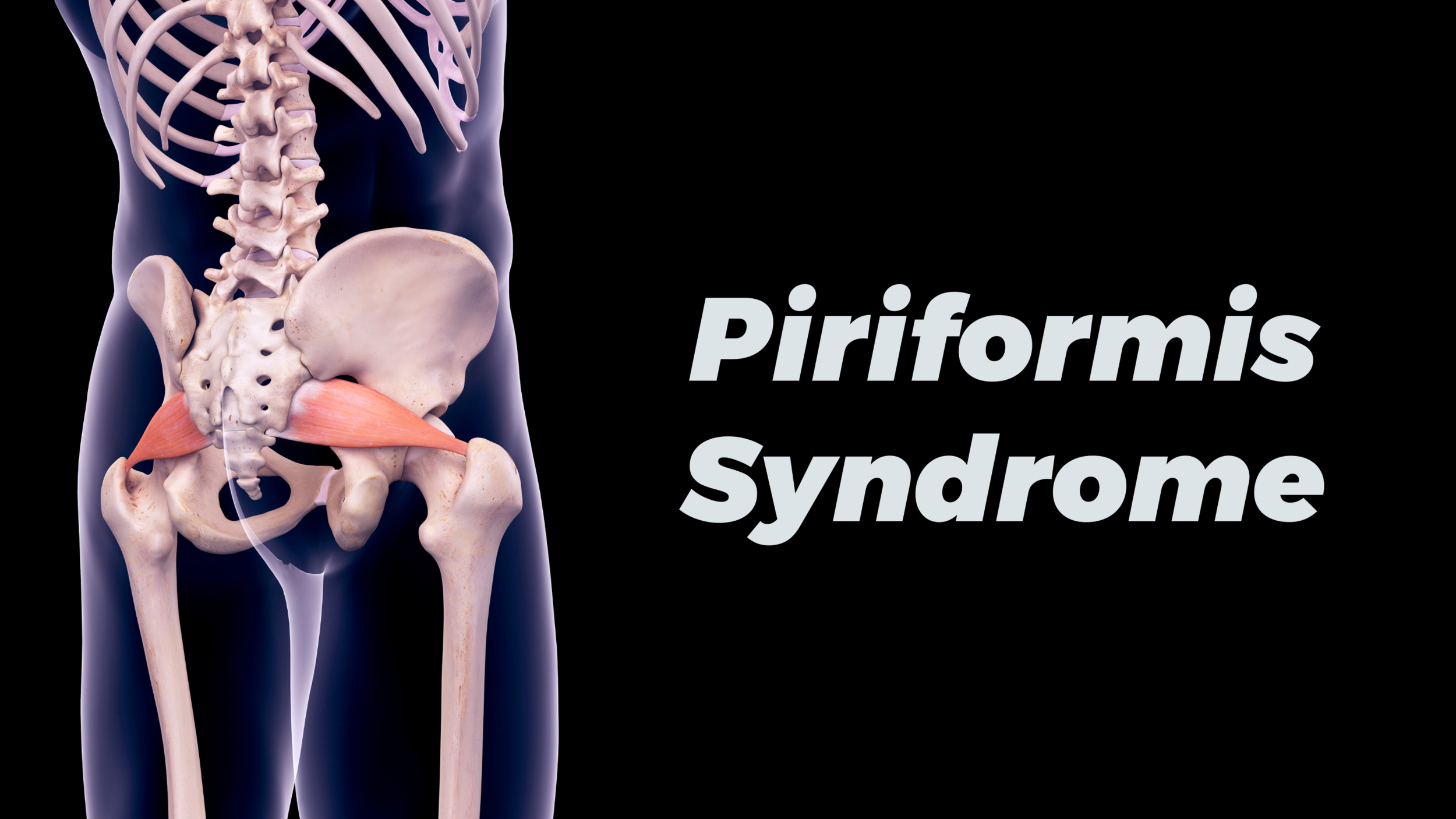 Piriformis Syndrome: Symptoms, Causes and Treatment