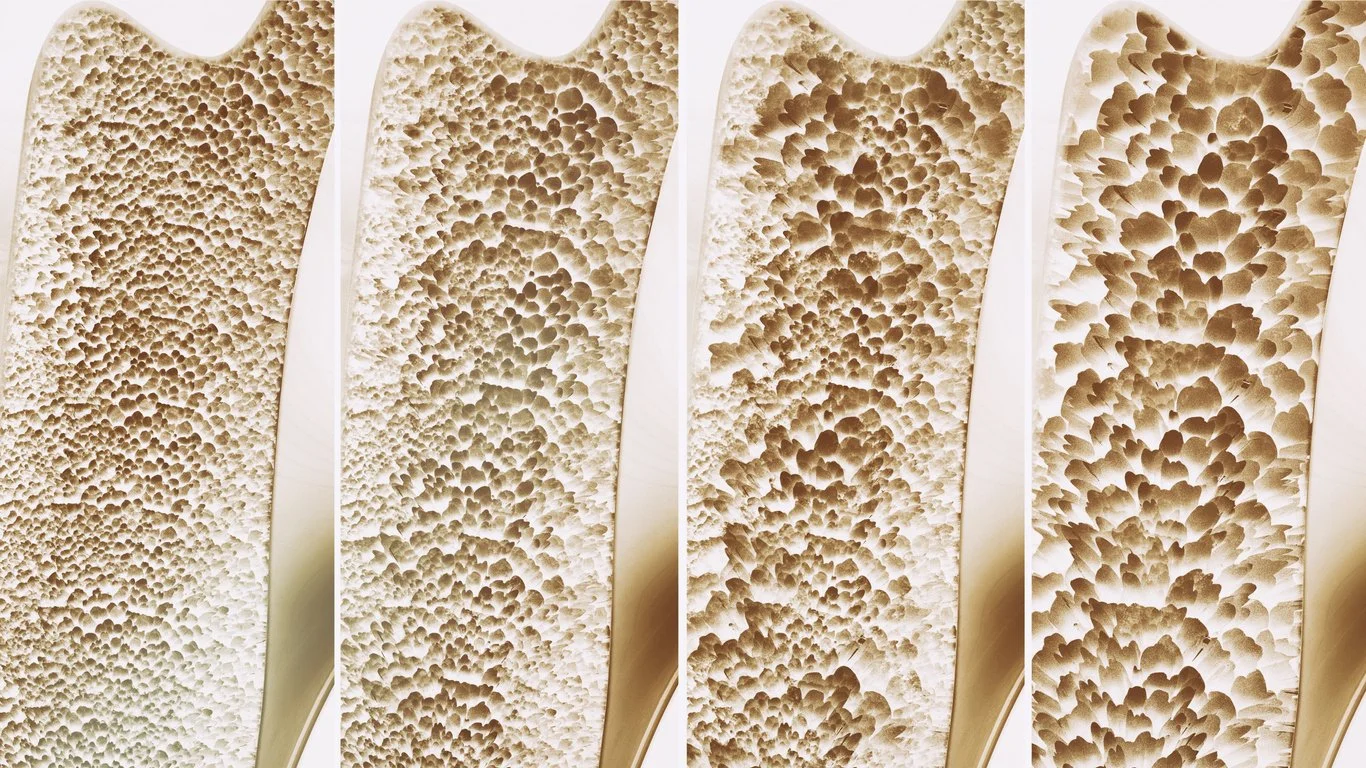 Natural osteopenia support, fracture healing