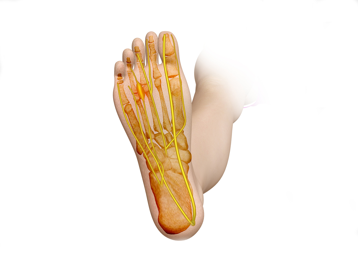 MORTONS-NEUROMA.jpg. 