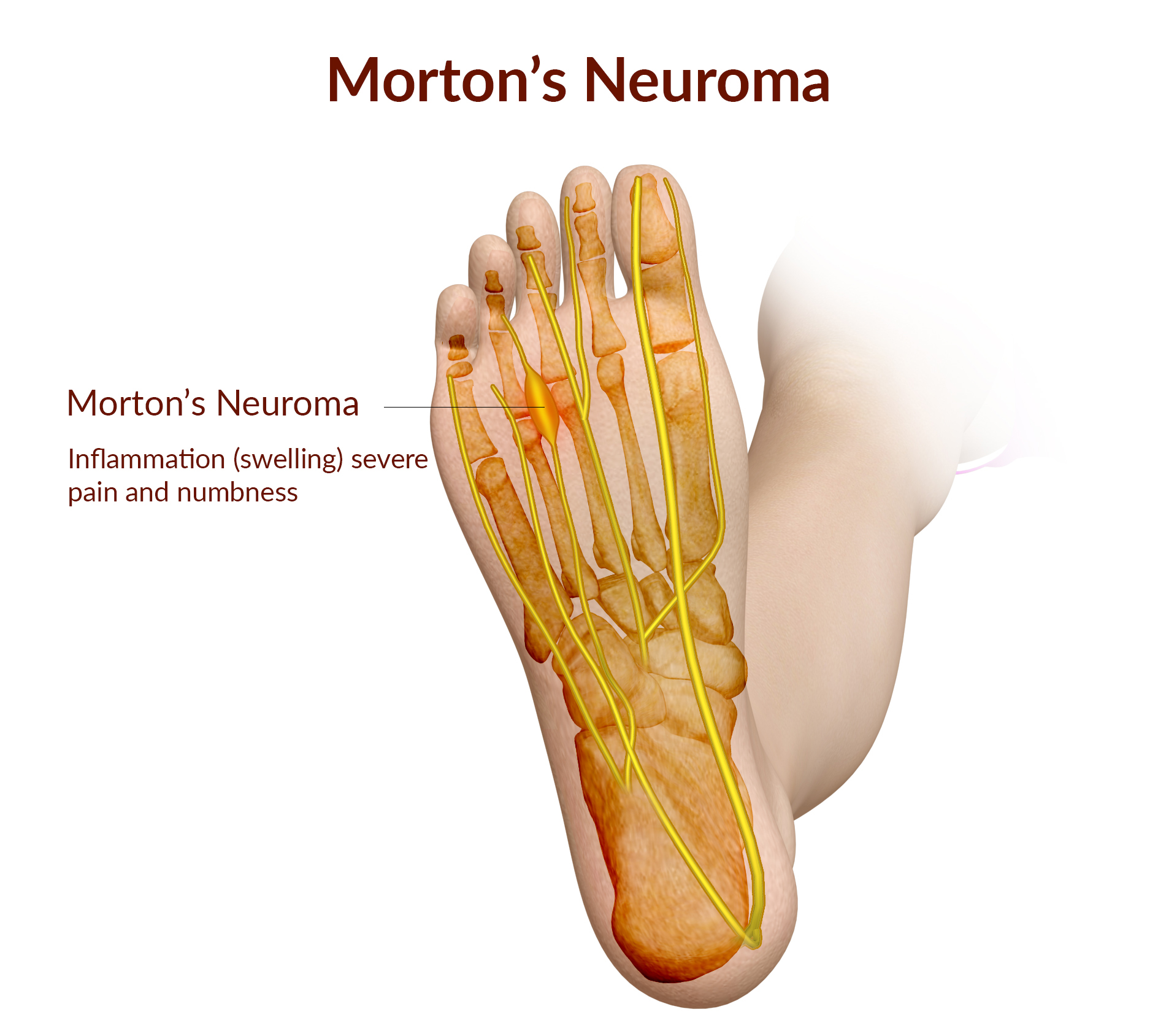 [Resim: MORTONS-NEUROMA-LABELS.jpg]