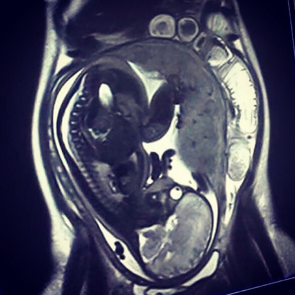 Wow this MRI image of mum and baby at 33 weeks gestation is quite revealing. 
Seeing just how squished mums organs are makes a lot of sense. Poor little bladder on the bottom  right. 
Original source unknown. I found this image on my friends page. Ch