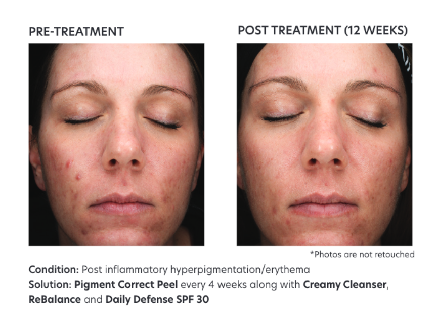 Reduce Visible Hyperpigmentation With the Pigment Correct Peel