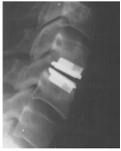 Figure 1 demonstrates a lateral X-ray with the implant in place..
